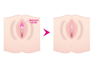 保険適用 しょういんしん縮小手術 小陰唇縮小手術