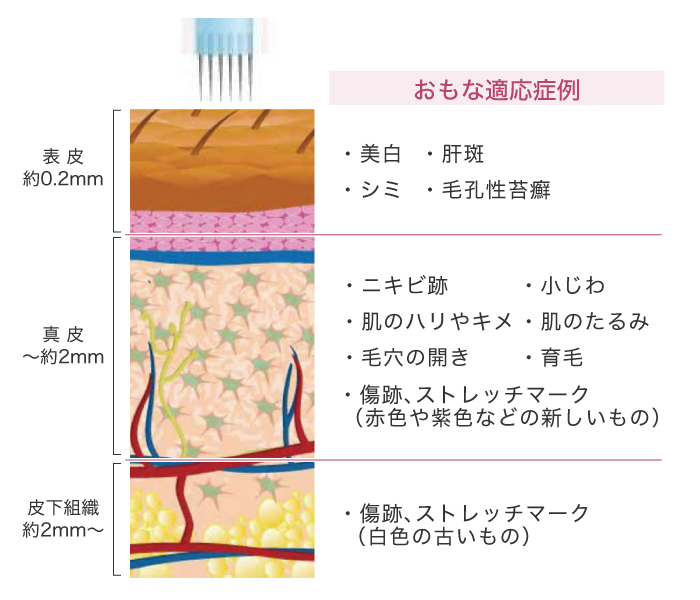 ダーマペンによる治療の適応