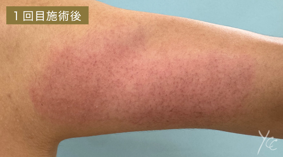 症例1 1回施術後
