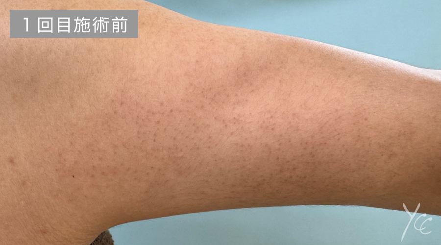 症例1施術前