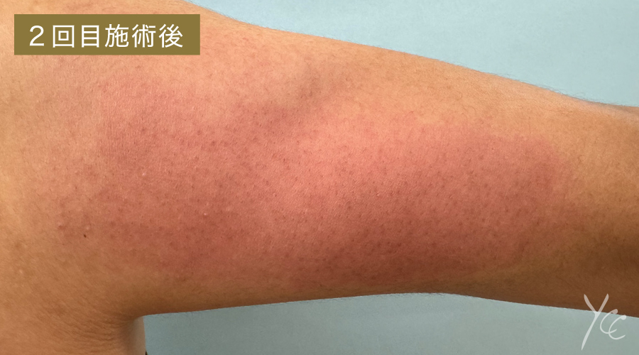 症例1 2回目施術後