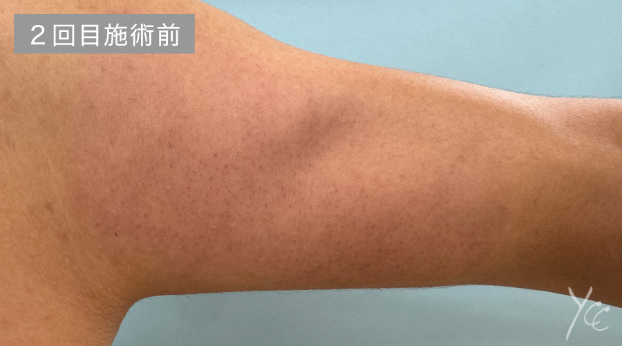 症例1 2回目施術前