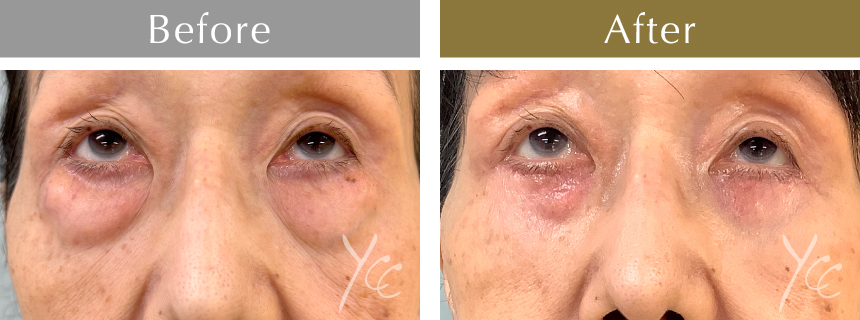 下眼瞼たるみ取り+脱脂症例写真