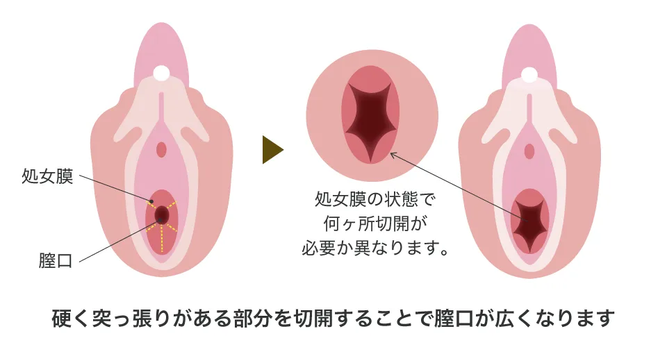 処女膜切開術の説明図｜硬く突っ張りがある部分を切開することで膣口が広くなります